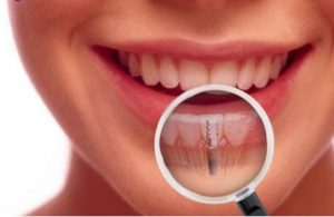 Ce trebuie sa stiti in legatura cu implanturile dentare?