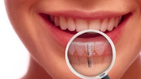 Ce trebuie sa stiti in legatura cu implanturile dentare?