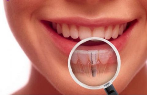 Ce trebuie sa stiti in legatura cu implanturile dentare?